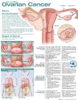 Book Cover for Understanding Ovarian Cancer Anatomical Chart by Anatomical Chart Company