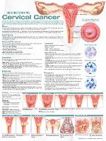 Book Cover for Understanding Cervical Cancer Anatomical Chart by Anatomical Chart Company