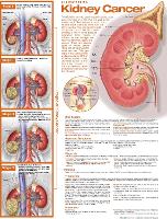 Book Cover for Understanding Kidney Cancer Anatomical Chart by Anatomical Chart Company