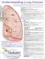 Book Cover for Understanding Lung Cancer Anatomical Chart by Anatomical Chart Company