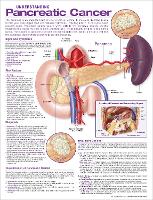 Book Cover for Understanding Pancreatic Cancer Anatomical Chart by Anatomical Chart Company