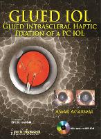 Book Cover for GLUED IOL by Amar Agarwal