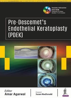 Pre-Descemet’s Endothelial Keratoplasty (PDEK)