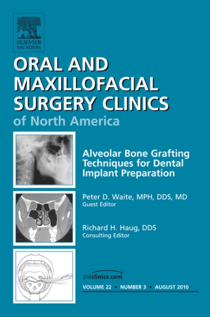 Book Cover for Alveolar Bone Grafting Techniques in Dental Implant Preparation, An Issue of Oral and Maxillofacial Surgery Clinics by Peter Waite