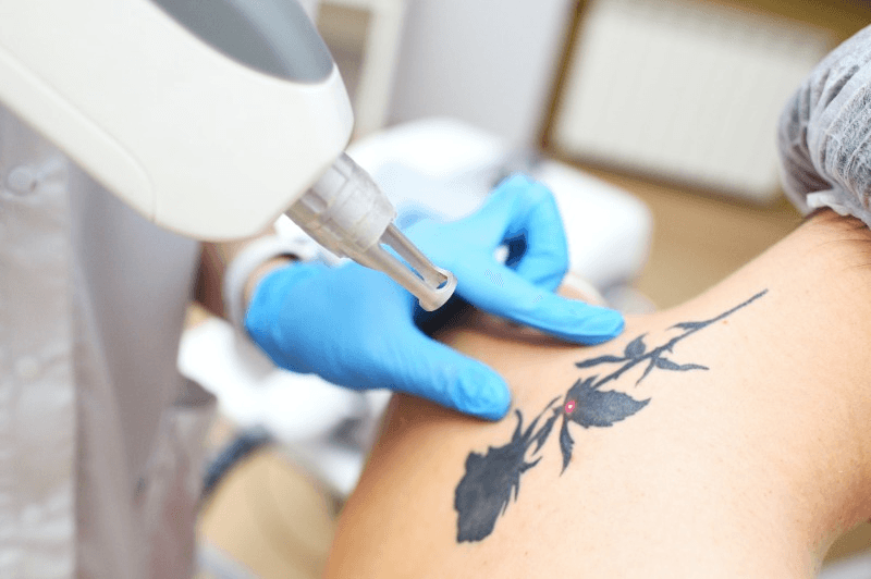 Lazer Tattoo Removal Procedure