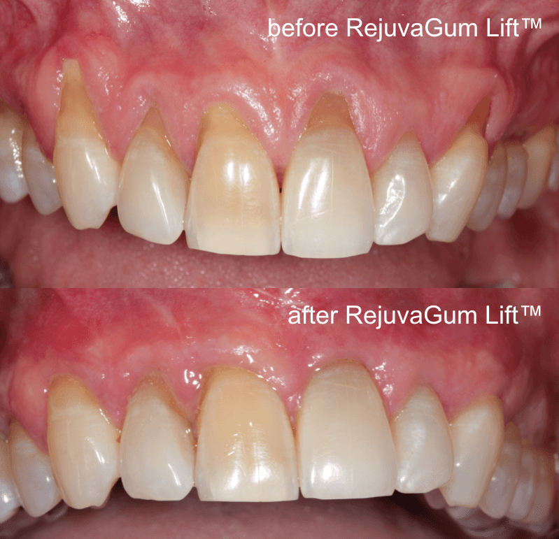 grum graft alternatives