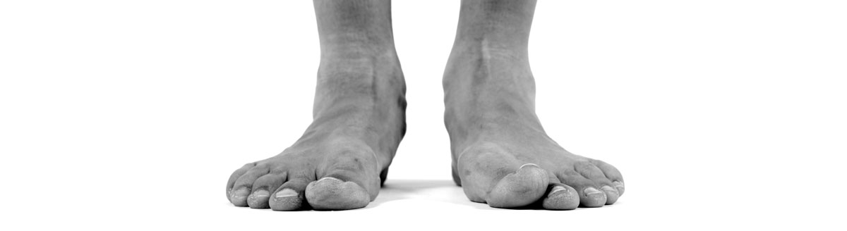 what you need to know about flat feet and fallen arches