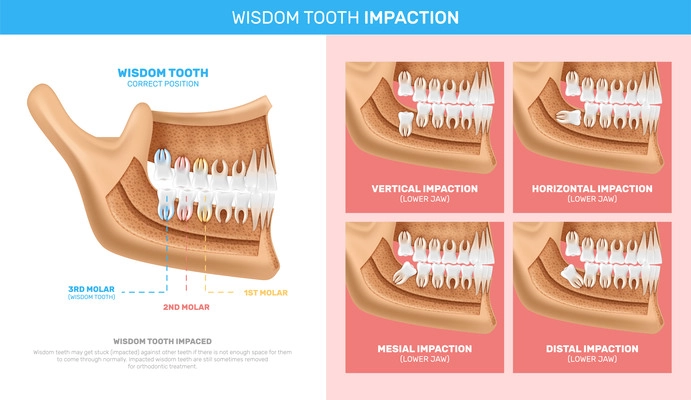 Wisdom tooth impaction infographics with anatomy chart and different options of problem realistic vector illustration