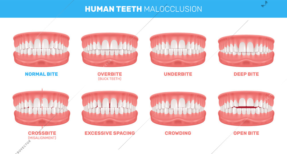 Human teeth malocclusion set with realistic images of mouth jaws with crooked teeth and text captions vector illustration