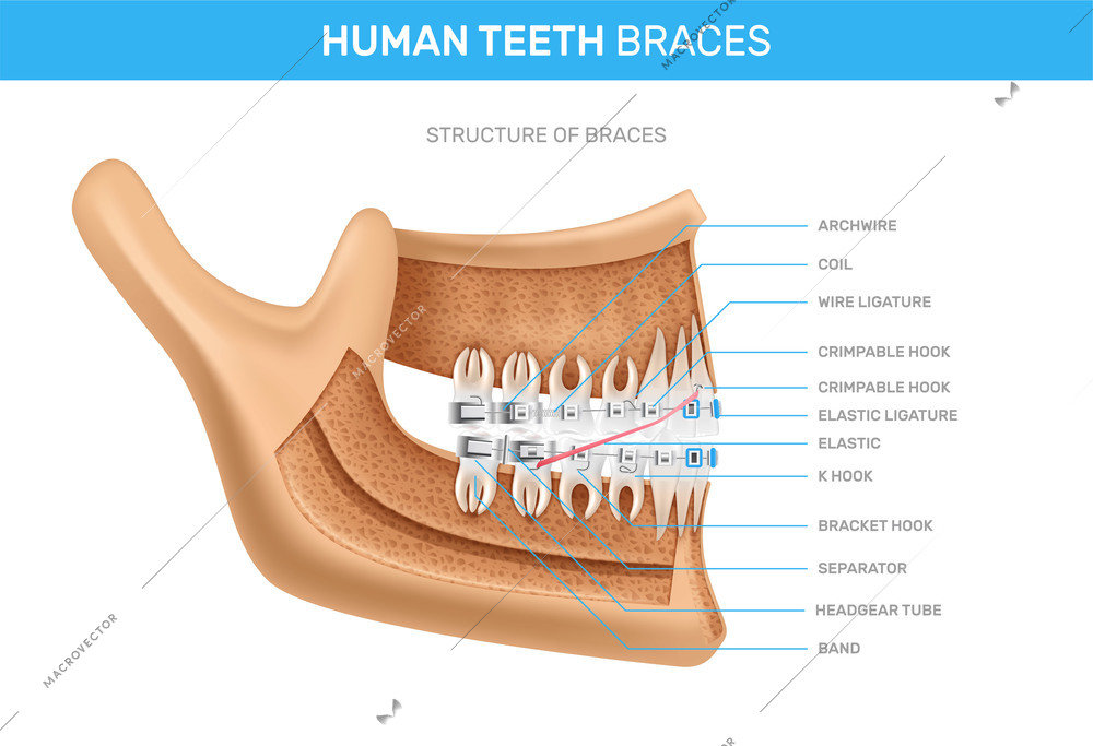 Human teeth braces infographics scheme with detailed description of structure  realistic vector illustration