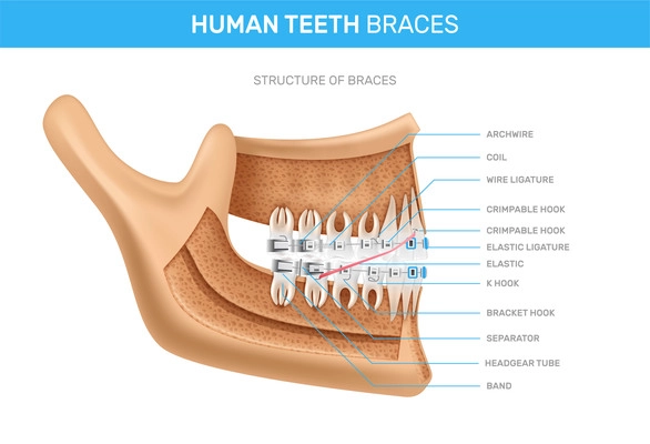 Human teeth braces infographics scheme with detailed description of structure  realistic vector illustration