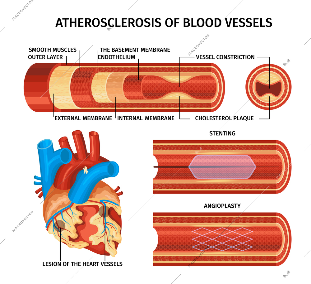 Realistic atherosclerosis infographic with stenting angioplasty descriptions smooth muscles outer layer the basement membrane endothelium external and internal membranes and cholesterol plaque descriptions vector illustration