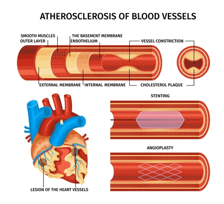 Realistic atherosclerosis infographic with stenting angioplasty descriptions smooth muscles outer layer the basement membrane endothelium external and internal membranes and cholesterol plaque descriptions vector illustration