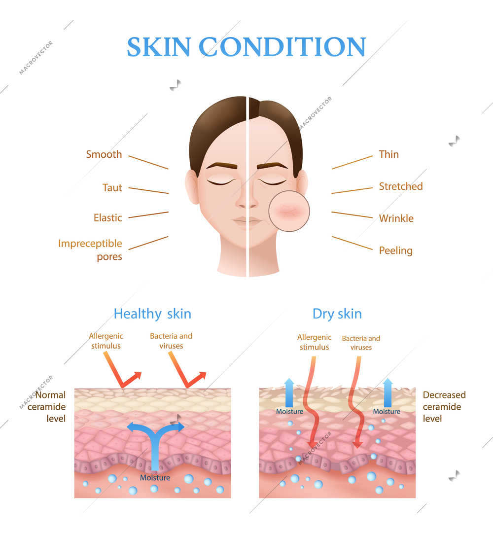 Realistic infographics showing structure of human healthy and dry skin with normal and decreased ceramide level vector illustration