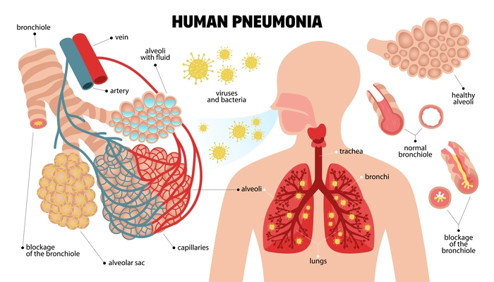 Human pneumonia set of infographic elements with anatomical scheme of respiratory system essentials with text captions vector illustration