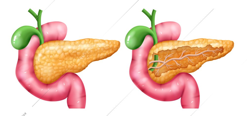 Realistic pancreas anatomy set with isolated images of normal and damaged pancreas with colored limb parts vector illustration