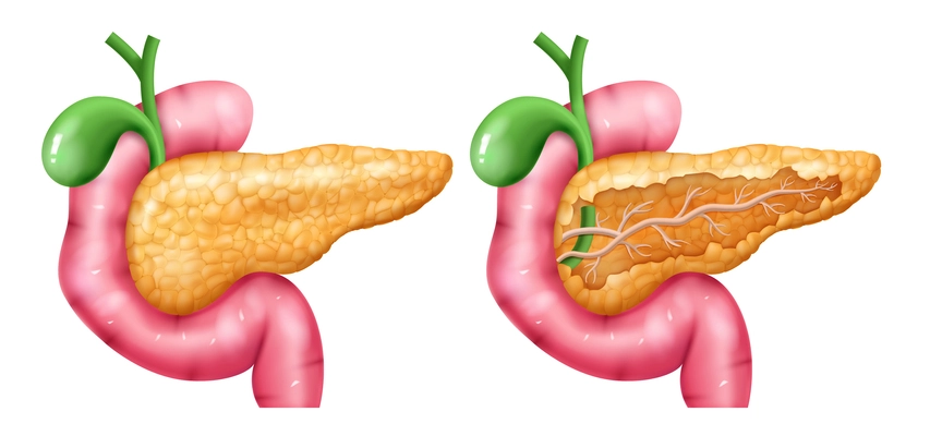 Realistic pancreas anatomy set with isolated images of normal and damaged pancreas with colored limb parts vector illustration