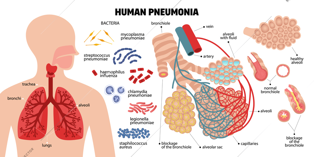 Human pneumonia composition with icons of infectious bacteria human lungs parts and text captions with pointers vector illustration