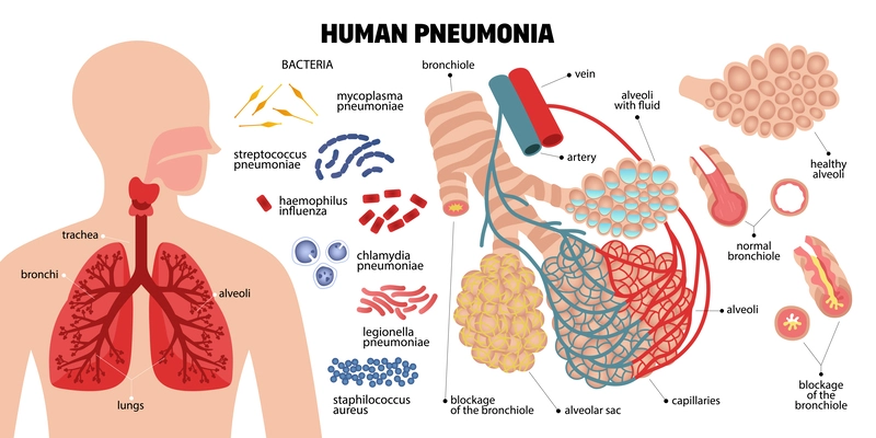 Human pneumonia composition with icons of infectious bacteria human lungs parts and text captions with pointers vector illustration