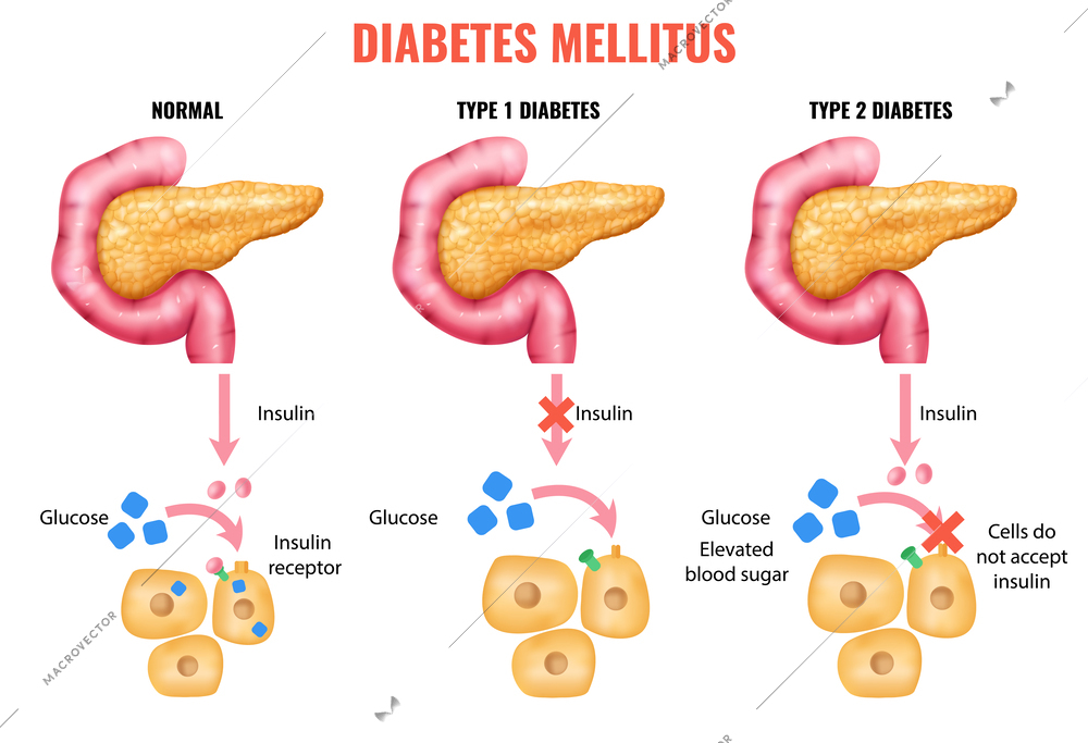 Realistic pancreas anatomy insulin diabetes mellitus infographics with notmal and damaged pancreas with editable text captions vector illustration