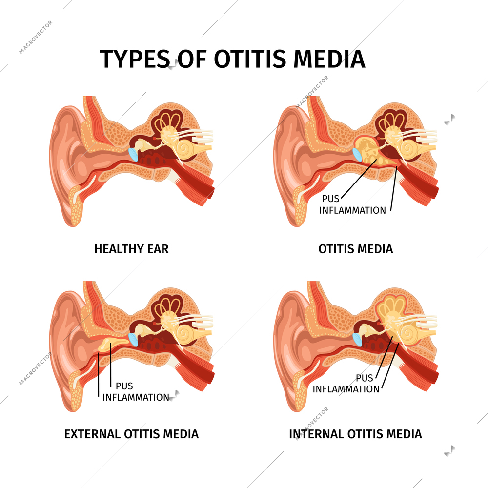 Realistic anatomy ear otitis set of four isolated anatomic diagrams with text captions and internal organs vector illustration