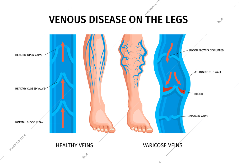 Venous disease of legs infographics  scheme of blood flow in healthy and varicose veins realistic vector illustration