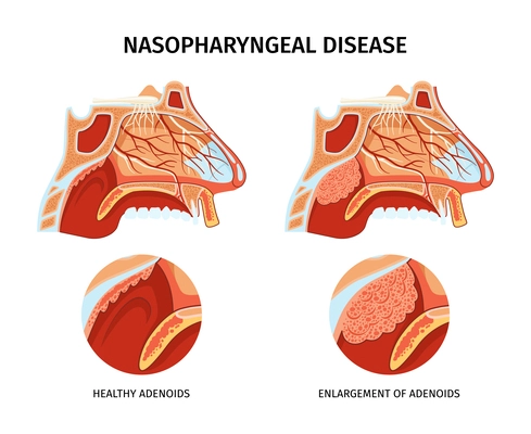 Nasopharyngeal disease poster with blood vessels nerves paranasal sinuses healthy and enlarged adenoids and flat vector illustration