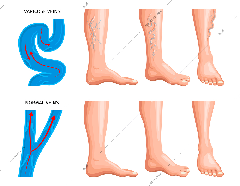 Varicose veins anatomy realistic set with magnifying scheme of blood vessels in healthy and damaged veins vector illustration