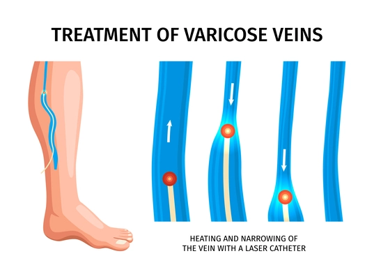 Treatment of varicose veins infographics poster depicting heating and narrowing of vein with laser catheter realistic vector illustration