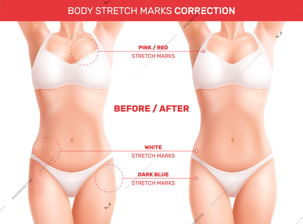 Female woman body stretch marks realistic composition with editable text pointers and before after correction views vector illustration