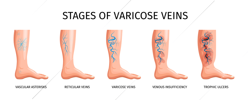 Stages of varicose veins so as vascular asterisks reticular veins venous insufficiency trophic ulcers isometric vector illustration