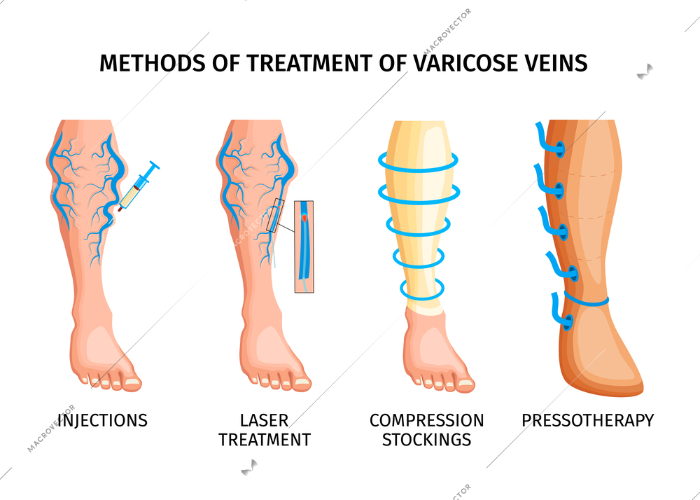 Methods of treatment of varicose veins realistic poster depicting injections laser treatment compression stockings pressotherapy vector illustration