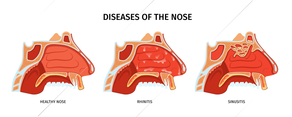 Diseases of nose anatomical cross section with healthy nose sinusitis and rhinitis realistic vector illustration