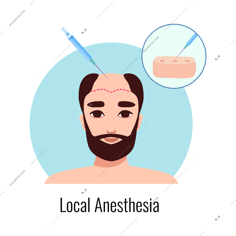 Alopecia hair transplantation composition with infographic image of hair restoration procedures with text vector illustration