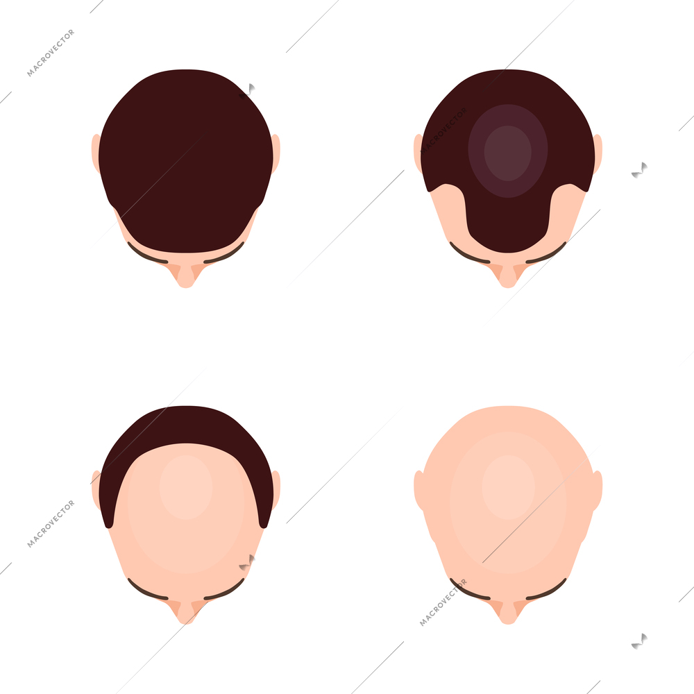 Alopecia hair transplantation composition with infographic image of hair restoration procedures vector illustration