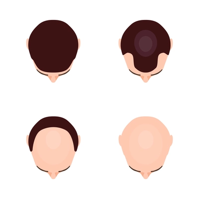 Alopecia hair transplantation composition with infographic image of hair restoration procedures vector illustration