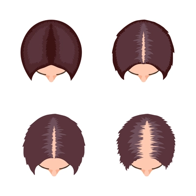 Alopecia hair transplantation composition with infographic image of hair restoration procedures vector illustration