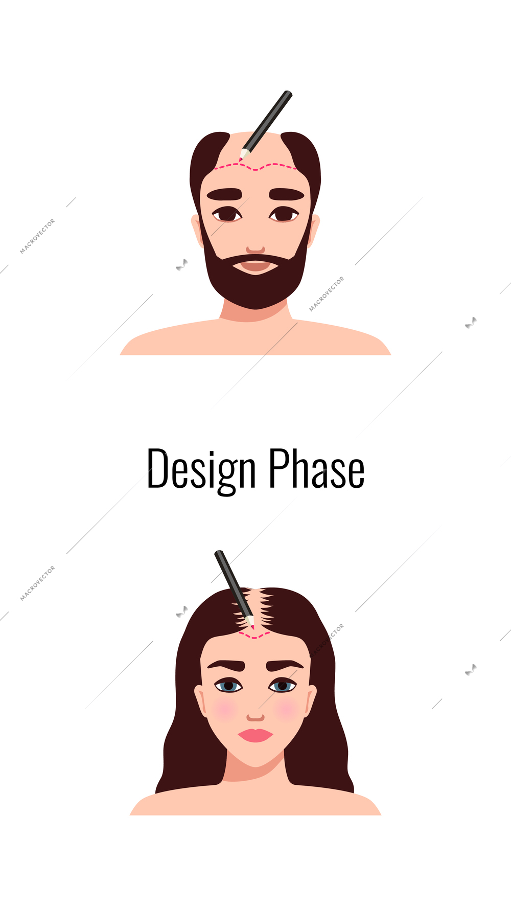 Alopecia hair transplantation composition with infographic image of hair restoration procedures with text vector illustration