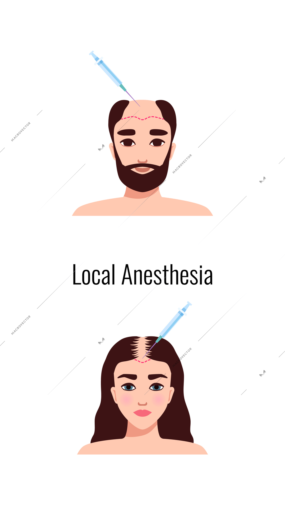 Alopecia hair transplantation composition with infographic image of hair restoration procedures with text vector illustration