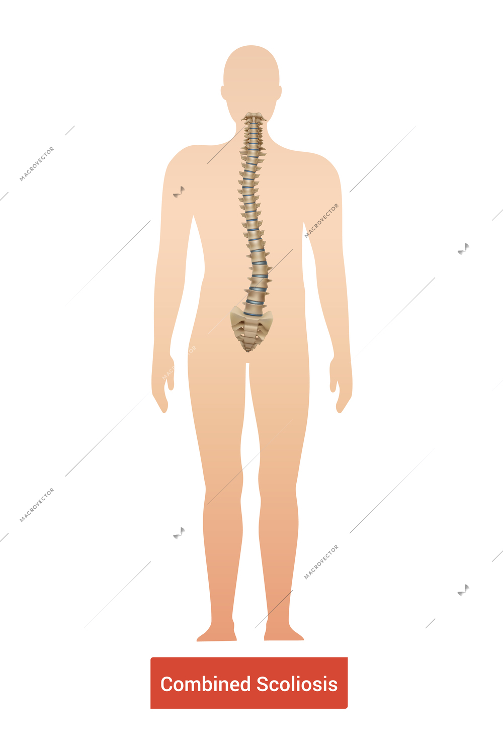 Spinal curvature scoliosis composition with anatomic view of human body silhouette with spine and text vector illustration