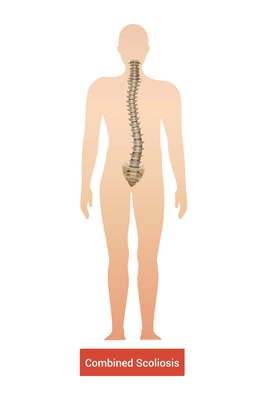 Spinal curvature scoliosis composition with anatomic view of human body silhouette with spine and text vector illustration