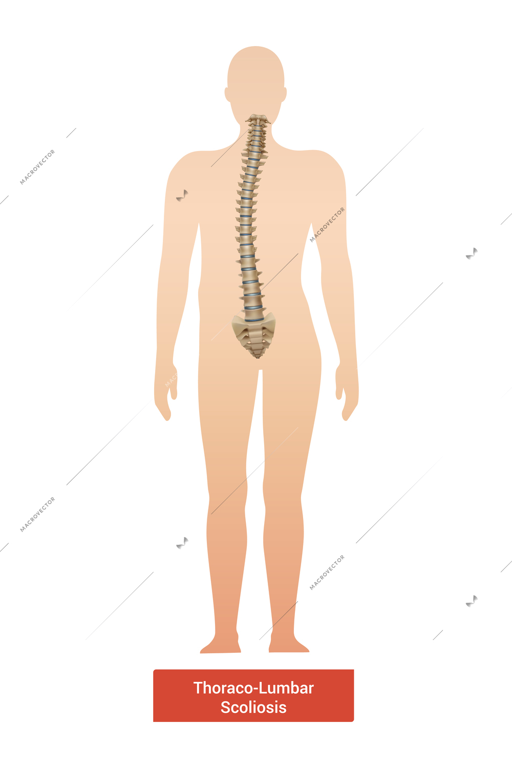 Spinal curvature scoliosis composition with anatomic view of human body silhouette with spine and text vector illustration