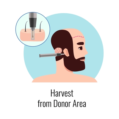 Alopecia hair transplantation composition with infographic image of hair restoration procedures with text vector illustration