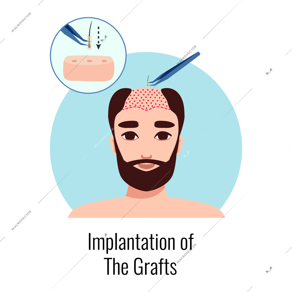 Alopecia hair transplantation composition with infographic image of hair restoration procedures with text vector illustration