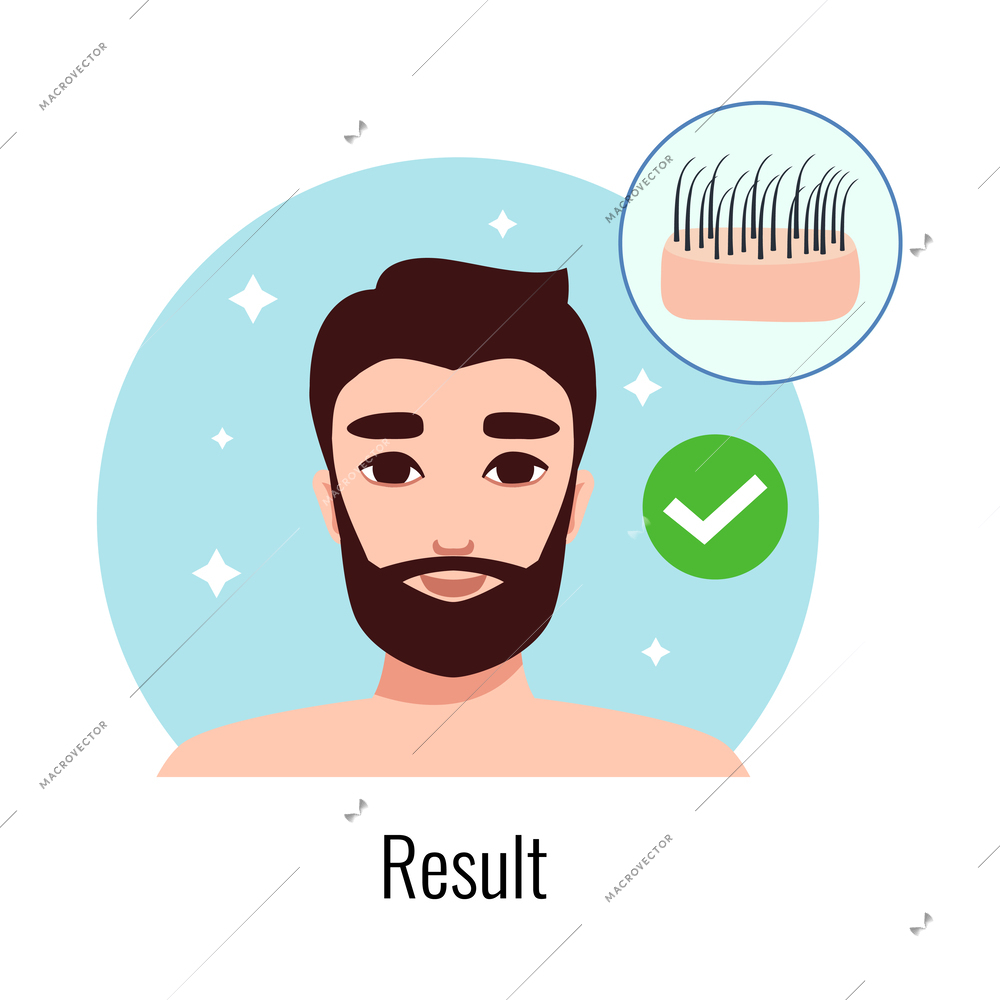 Alopecia hair transplantation composition with infographic image of hair restoration procedures with text vector illustration