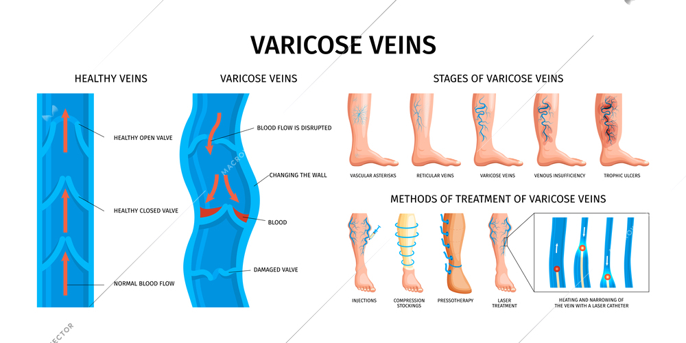 Varicose veins realistic infographics  vector illustration with stages of illness scheme of damaged and healthy valves and methods of treatment