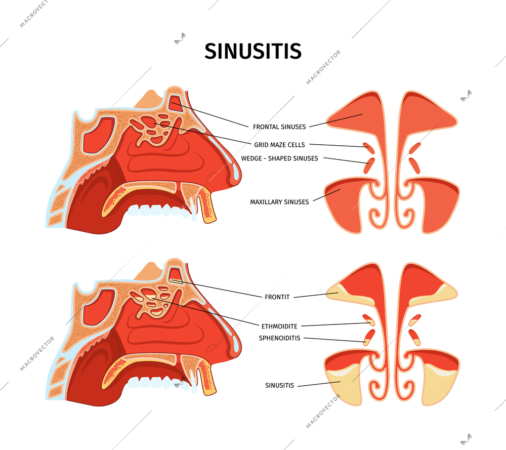 Sinusitis infographics cross section poster depicting inflammation of paranasal sinuses including maxillary frontal and grid maze cells realistic vector illustration