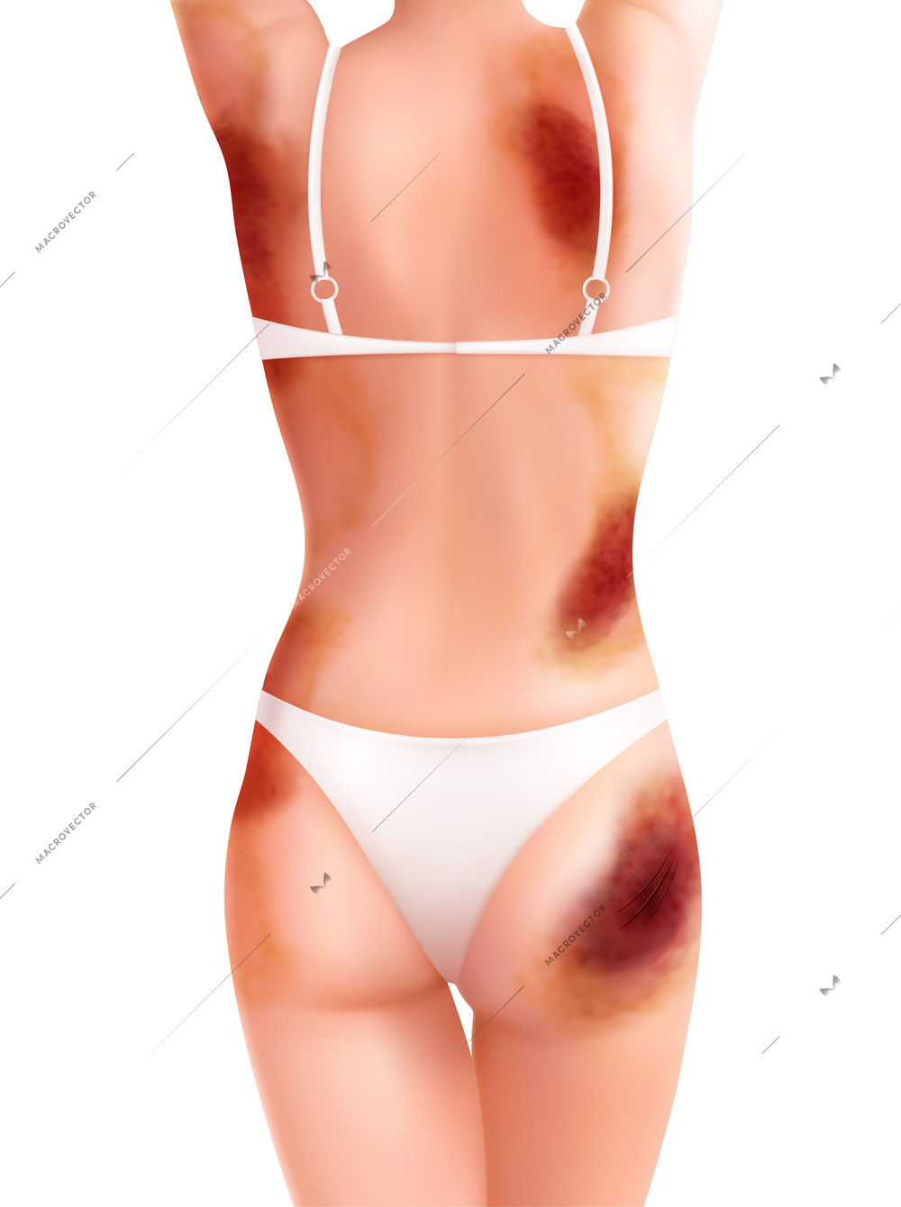 Injured woman realistic composition with view of female body in lingerie with multiple bruises on skin vector illustration