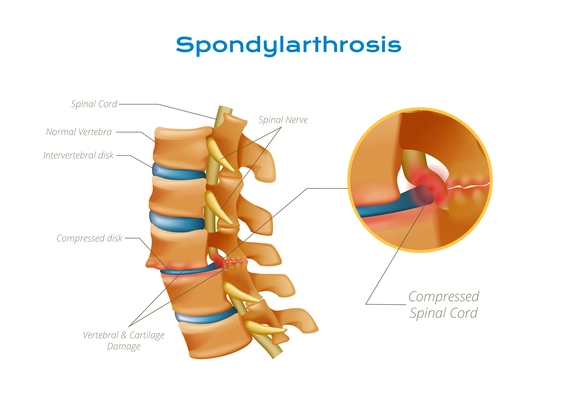 Vertebrae spinal cord anatomy infographics with editable text pointers and circle view of compressed spinal nerve vector illustration