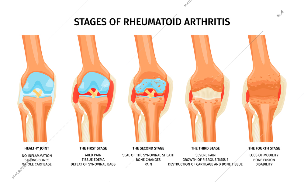 Realistic infographics showing four stages of rheumatoid arthritis of knee joint vector illustration